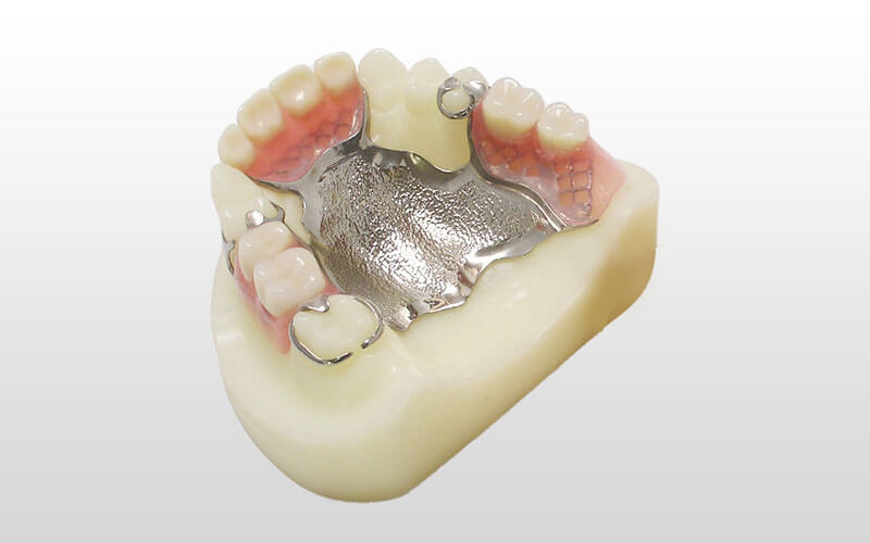 金属床義歯義歯