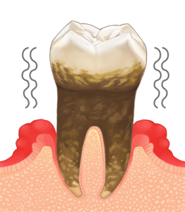 歯周病３
